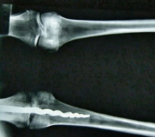 La barra metálica puede verse nítidamente en esta imagen de rayos X (Universidad Brigham Young)