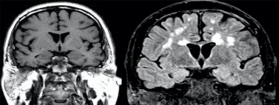 Cerebros afectados Cerebros afectados