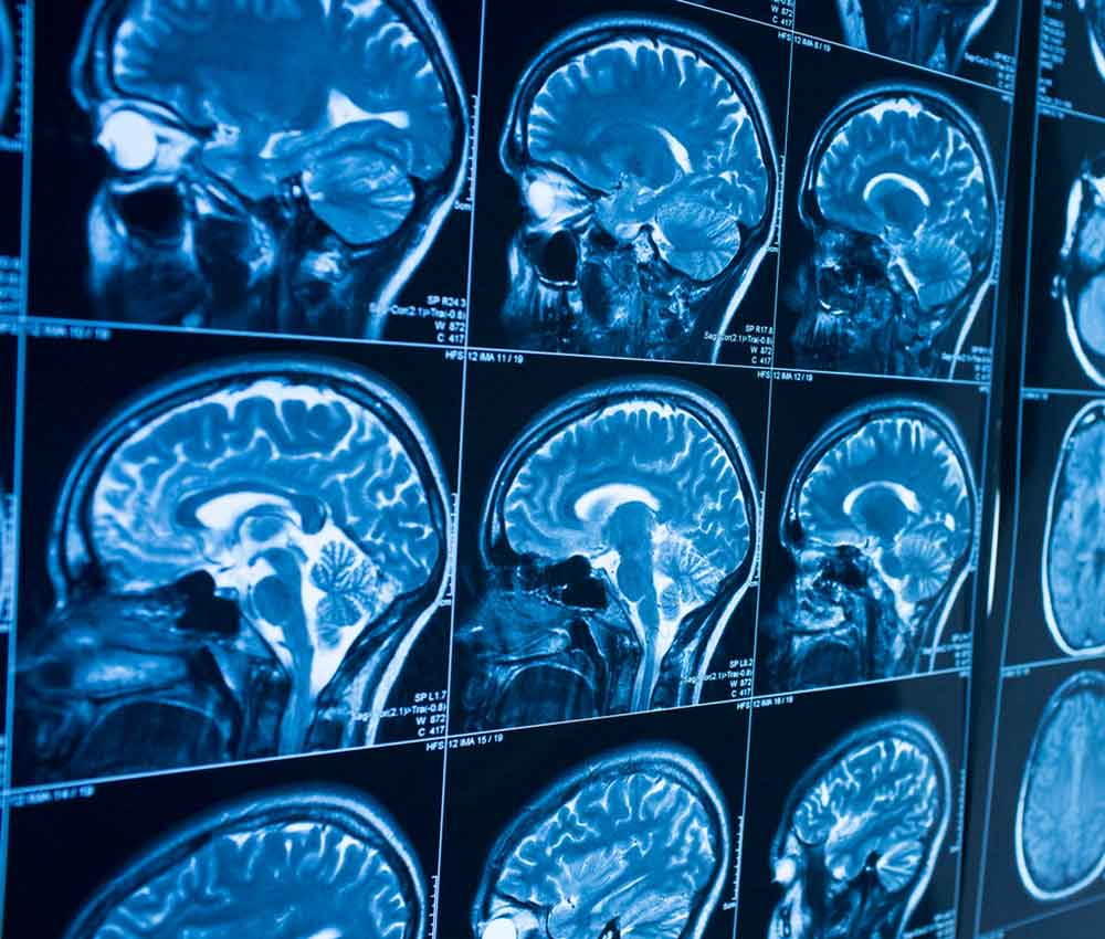 Singularidades en el cerebro de los testigos ovni Singularidades en el cerebro de los testigos ovni