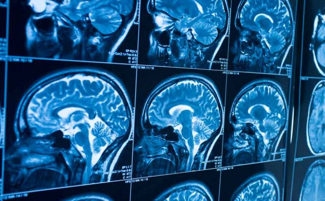 Singularidades en el cerebro de los testigos ovni