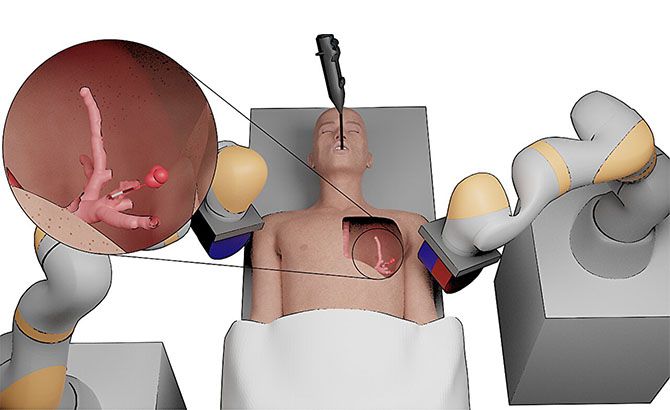 Minirrobots tratan el cáncer pulmonar