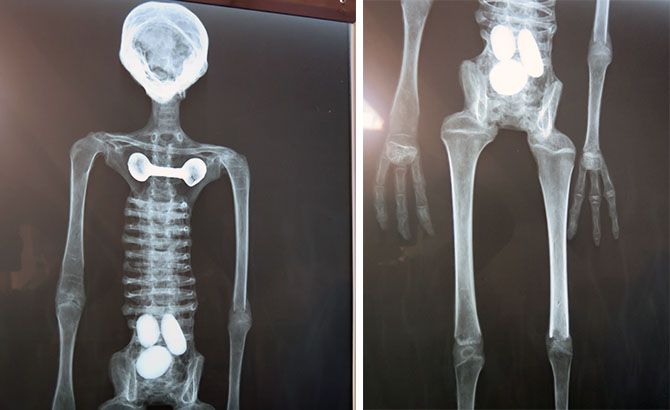 Los Rayos X practicados a Josefina