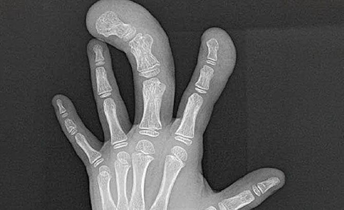 Esta radiografía muestra macrodistrofia en la mano izquierda