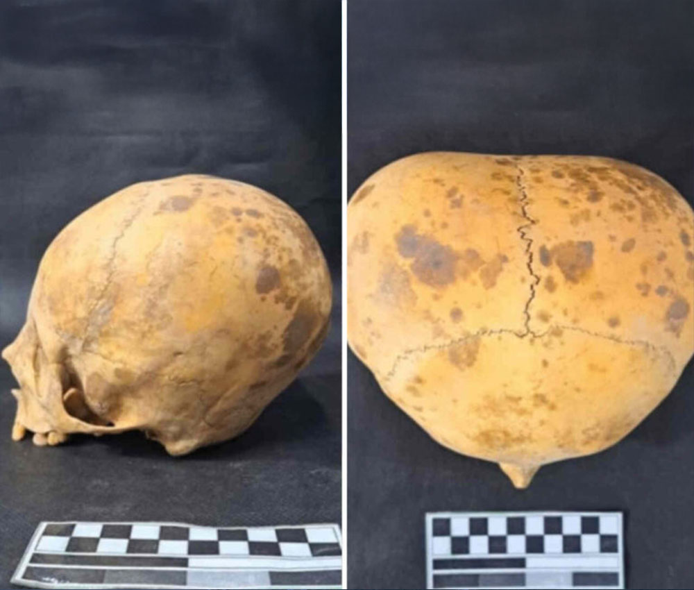 Dos imágenes del supuesto cráneo extraterrestre de Catamarca