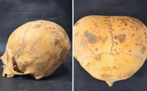 Dos imágenes del supuesto cráneo extraterrestre de Catamarca