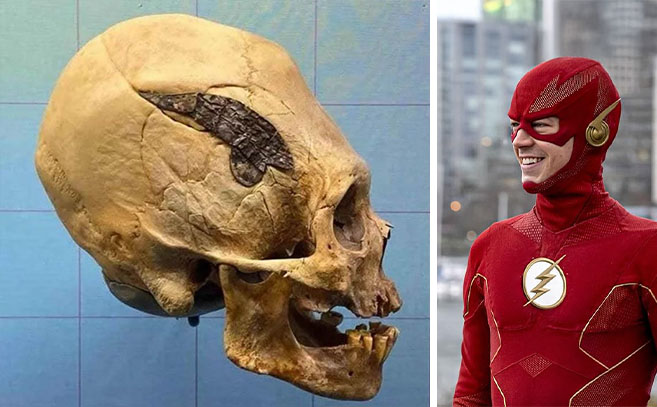 la prótesis del cráneo de Oklahoma recuerda al traje de Flash la prótesis del cráneo de Oklahoma recuerda al traje de Flash