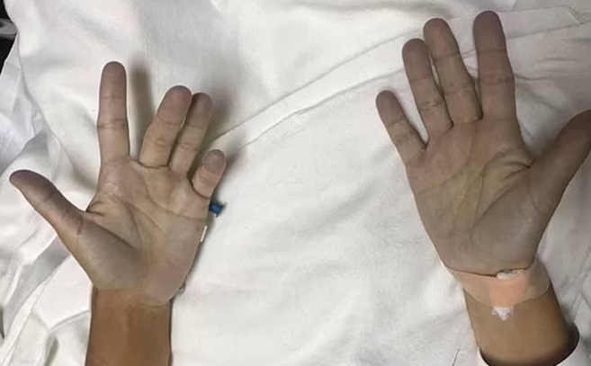 La metahemoglobinemia es un trastorno sanguíneo muy poco frecuente que provoca una coloración azulada de la piel La metahemoglobinemia es un trastorno sanguíneo muy poco frecuente que provoca una coloración azulada de la piel