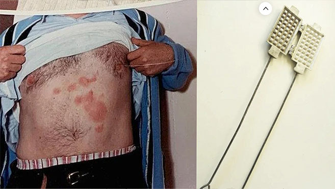 Las quemaduras originales de Michalak no se parecen en nada a las que acreditó posteriormente