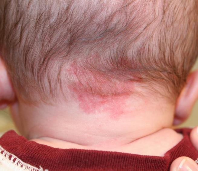 ¿Prueban las marcas de nacimiento una muerte violenta en vidas pasadas?