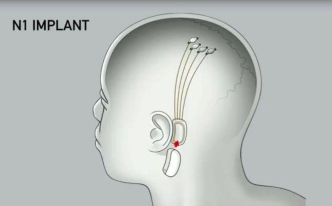 conectar cerebro ordenador implante